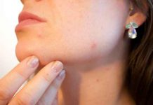 KO IMA AKNE, ŽIVI DUŽE: Lekari otkrili vezu između problematične kože i dugovečnosti